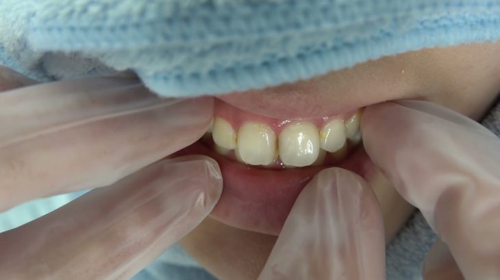 【前歯の歯並び120】４歯のピンポイントビューティ　ダイヤモンド今井院長のセラミック矯正