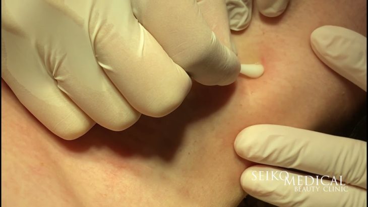 アクロコルドン｜セイコメディカルビューティクリニック