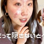 【ニキビ肌 メイク】ニキビを隠さないメイク〜ニキビ・ニキビ跡・肌荒れは隠さないとダメですか？ニキビ治療中〜