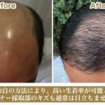 【梅田】自毛植毛の効果の相談｜ウェルネスビューティクリニック大阪院