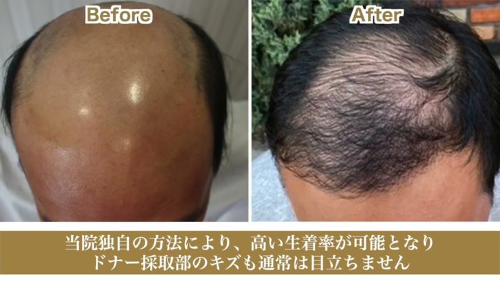 【梅田】自毛植毛の効果の相談｜ウェルネスビューティクリニック大阪院