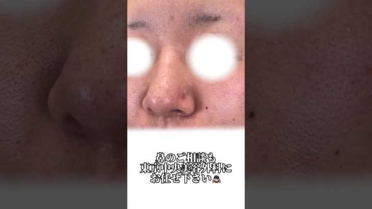 【鼻整形】海外メイクに憧れて..#shorts