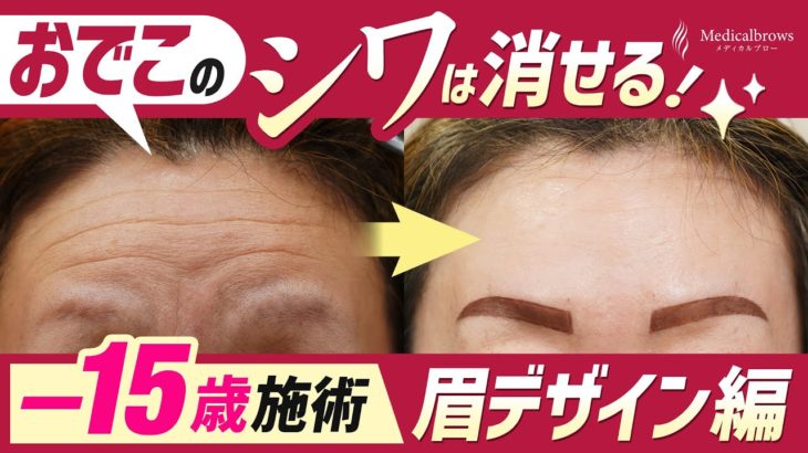 【実話】-15歳若返る、最強コンボ治療「シワ取り＆アートメイク」52歳の美容施術に密着！