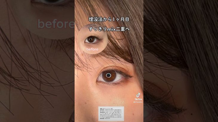 無料モニター募集中。詳細はInstagramで#アイメイク #埋没法 #doubleeyelidsurgery #フォーエバー二重術 #二重埋没 #二重整形 #おすすめ#コスメ #cosmetics