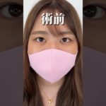 【二重整形】今のままじゃ大好きなギャルメイクができないので、、、　#shorts