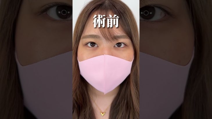 【二重整形】今のままじゃ大好きなギャルメイクができないので、、、　#shorts