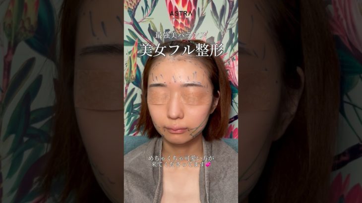 フル整形で【最強美バランス誕生‼️】 #astrabeautyclinic #アストラビューティクリニック #美容整形 #忘れ鼻 #鼻整形