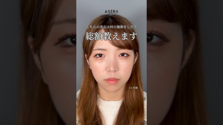 【鼻整形の総額教えます❗️】大人気総額シリーズ✨ #astrabeautyclinic #アストラビューティクリニック #美容整形 #忘れ鼻 #鼻整形 #小鼻縮小