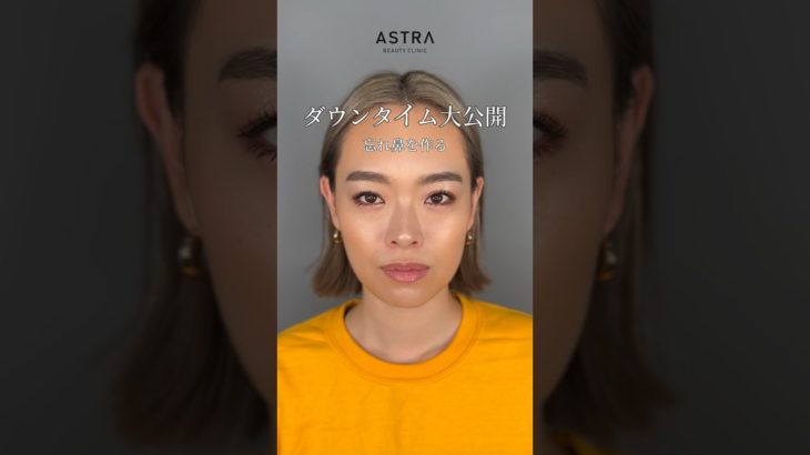 【ダウンタイム大公開しちゃいます👀】 #astrabeautyclinic #アストラビューティクリニック #美容整形 #忘れ鼻 #鼻整形 #小鼻縮小