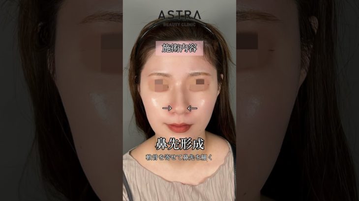 鼻天才TWICEサナちゃん✨の鼻になれる？！#astrabeautyclinic #アストラビューティクリニック #鼻整形 #美容整形 #twice#サナ