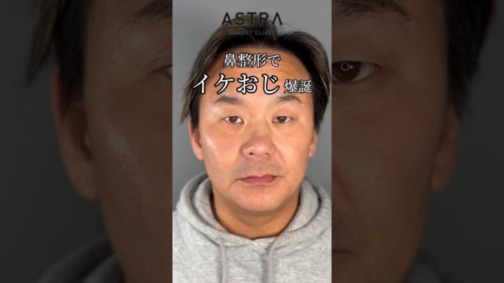 鼻整形でイケおじ爆誕👨🏻✨#アストラビューティクリニック #astrabeautyclinic #美容整形 #鼻整形 #メンズ美容 #イケオジ