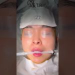 鼻先で顔の印象変わります👩🏼‍⚕️✨#アストラビューティクリニック #astrabeautyclinic #美容整形 #鼻整形