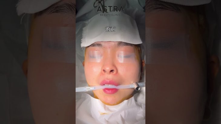 鼻先で顔の印象変わります👩🏼‍⚕️✨#アストラビューティクリニック #astrabeautyclinic #美容整形 #鼻整形