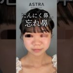 にんにく鼻から忘れ鼻に👩🏼‍⚕️✨#アストラビューティクリニック#astrabeautyclinic #美容整形#鼻整形#にんにく鼻#忘れ鼻