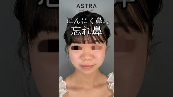 にんにく鼻から忘れ鼻に👩🏼‍⚕️✨#アストラビューティクリニック#astrabeautyclinic #美容整形#鼻整形#にんにく鼻#忘れ鼻