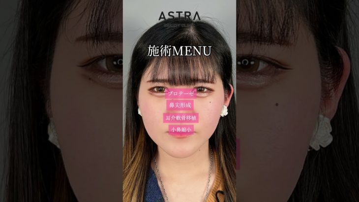 鼻フル整形ここまで変わる✨#アストラビューティクリニック#astrabeautyclinic #美容整形#鼻整形#忘れ鼻#垢抜ける方法