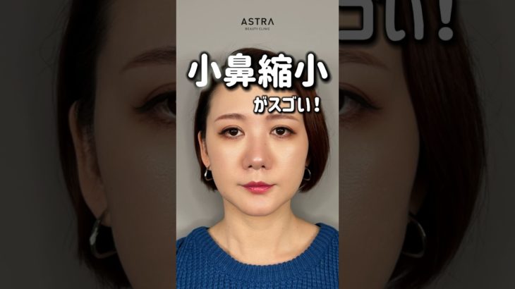 【小鼻縮小だけでこんなに変わるの⁉️】#アストラビューティクリニック #忘れ鼻 #美容整形 #鼻整形 #塩満恵子 #小鼻縮小