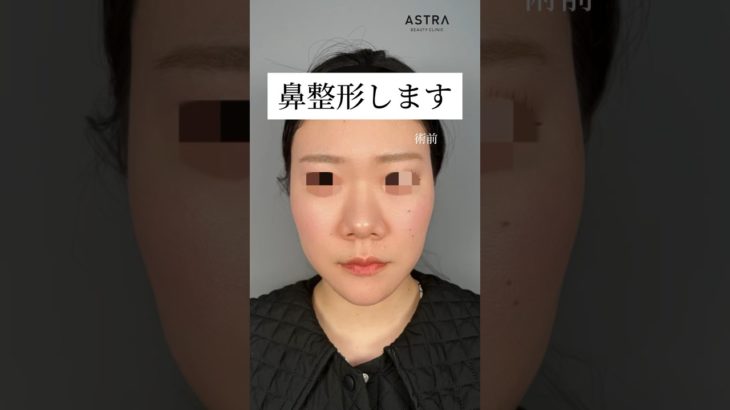 たった1ヶ月で美鼻誕生✨ #アストラビューティクリニック #鼻整形 #忘れ鼻 #塩満恵子