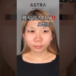 どんなお鼻もキレイに💖#astrabeautyclinic #アストラビューティクリニック #鼻整形 #美容整形 #忘れ鼻 #鼻中隔延長