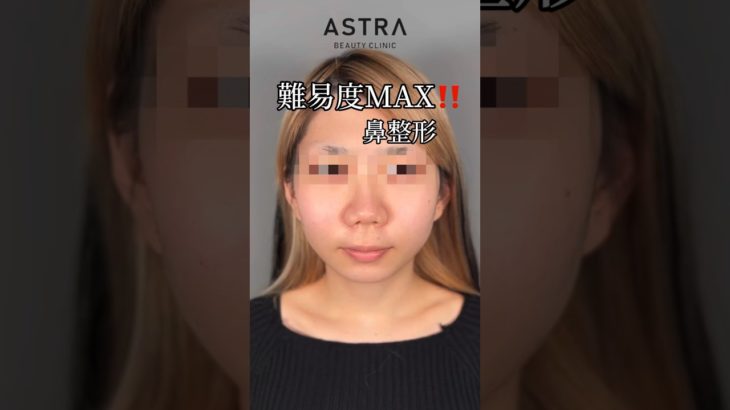 どんなお鼻もキレイに💖#astrabeautyclinic #アストラビューティクリニック #鼻整形 #美容整形 #忘れ鼻 #鼻中隔延長