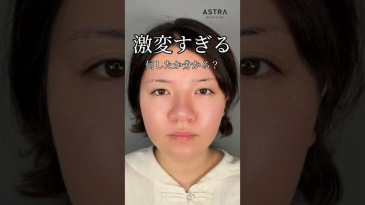 何したか分かる❓#アストラビューティクリニック #美容整形 #鼻整形 #忘れ鼻 #塩満恵子