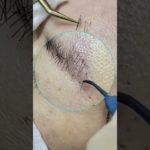 #eyebrowtransplant #eyebrows #植眉 #browtransformation #beauty #makeup #eyebrowtransplantation #眉毛种植