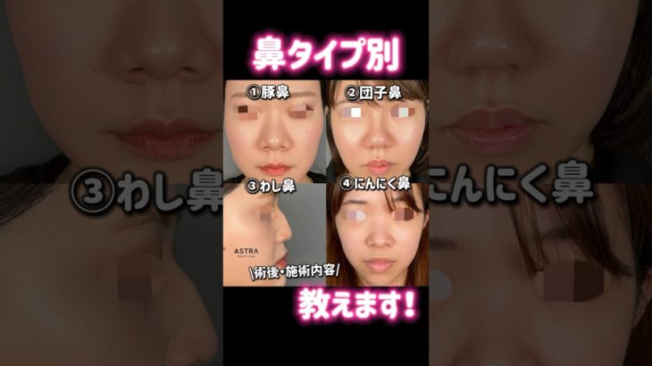 あなたの鼻は何タイプ❓💭#アストラビューティクリニック #鼻整形 #美容整形 #塩満恵子 #忘れ鼻