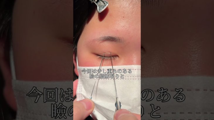 【二重整形】クールビューティ二重🩷#shorts