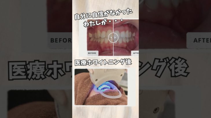 医療ホワイトニングの効果　 #歯医者 #ビューティ #ビューティー