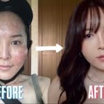 【GRWM】ダウンタイムでパンパンに腫れ上がったハムスター顔でもメイクの力でここまで可愛くなれるんダ！【雑談】