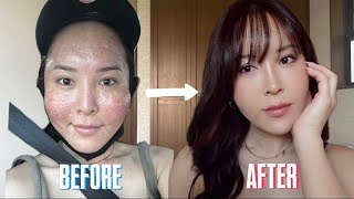 【GRWM】ダウンタイムでパンパンに腫れ上がったハムスター顔でもメイクの力でここまで可愛くなれるんダ！【雑談】