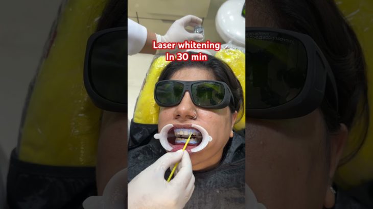 ‼️OFFER⁉️laser whitening @ 5999/- till January 2025 #beauty #transition #makeover #digital #makeup