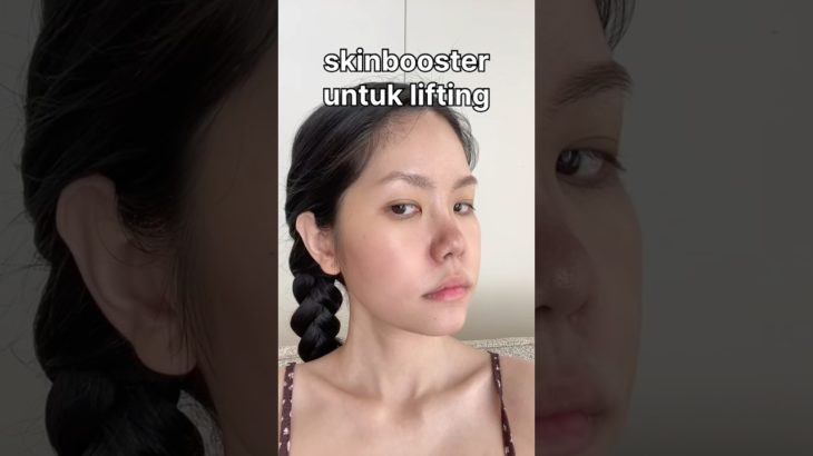 NUCLEOFILL STRONG DI KLINIK JAKARTA 🥰💗 l Review vorta beauty clinic