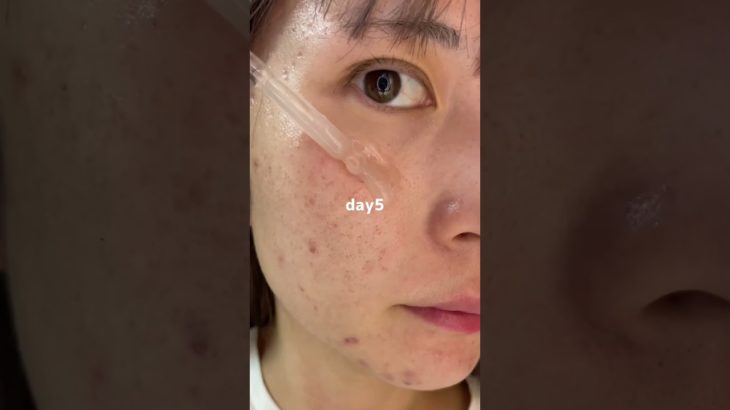 毎日増える肌荒れから解放されました#pr #プレミアムビューティセラムaz #シシベラ美容液#肌悩み