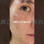 流石にこれ知らないとやばいよね？#pr #プレミアムビューティセラムaz #シシベラ美容液 #ニキビ跡