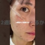 ニキビ潰したから速攻で美容液ぶち込んだ結果#pr#プレミアムビューティセラムAZ#シシベラ美容液#美容液