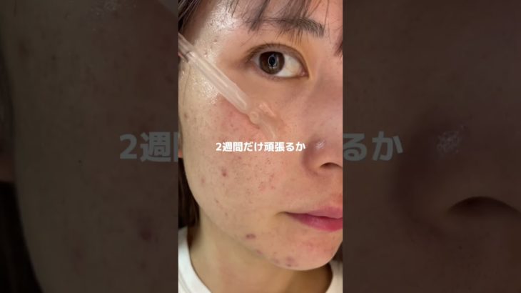 ニキビ潰したから速攻で美容液ぶち込んだ結果#pr#プレミアムビューティセラムAZ#シシベラ美容液#美容液
