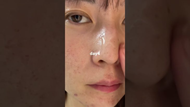 クリスマスまでに肌荒れ治したい！#pr派プレミアムビューティセラムAZ#シシベラ美容液#スキンケア