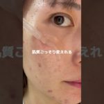 顔シラミってやつ酷い…。#pr#プレミアムビューティセラムaz #シシベラ美容液#スキンケア #美容液