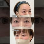 姫路でクマ取りするならショウズビューティクリニックへ🌟40代・50代・60代のお客様、増えています！ #shorts #美容クリニック