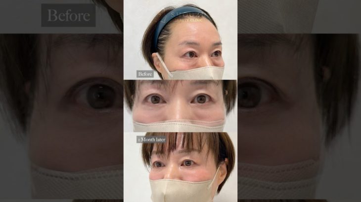 姫路でクマ取りするならショウズビューティクリニックへ🌟40代・50代・60代のお客様、増えています！ #shorts #美容クリニック