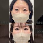 姫路でクマ取りするならショウズビューティクリニックへ☺️老け見えの原因のクマ、取って若々しく明るい目元へ！ #shorts  #美容クリニック