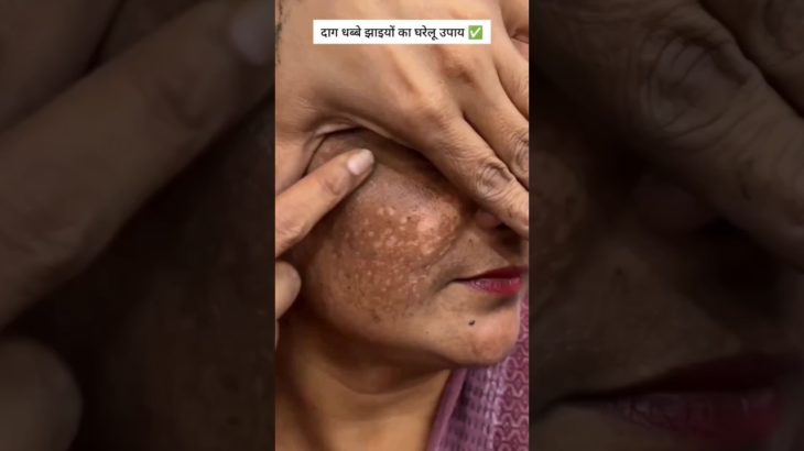 ✅Remove Darkspots & Pigmentation Naturally | #shorts #skincare #beauty